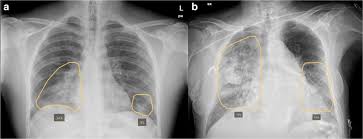 Goa Uses AI to Review Over 1 Lakh Chest X-Rays for Early Lung Disease Detection